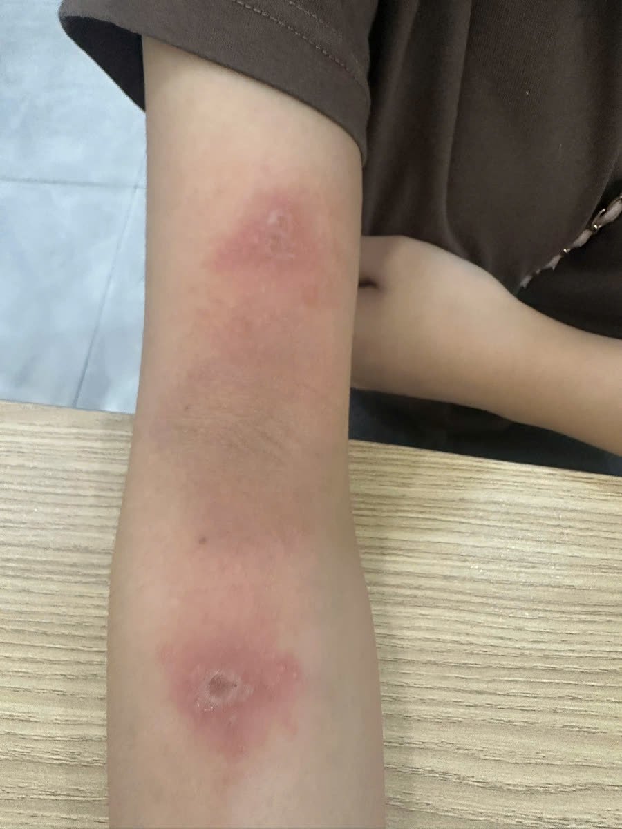 Vết kiến ba khoang đốt trên cánh tay: hai mảng đỏ, giữa có vảy khô và vết trợt nhỏ, vài ngày sau khi tiếp xúc