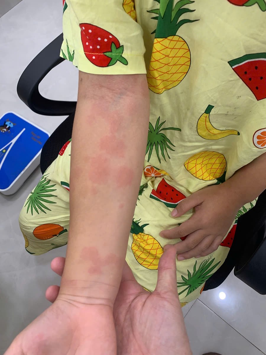 Cẳng tay trẻ nổi mày đay với các mảng sẩn phù hồng đỏ rải rác từ khuỷu xuống cổ tay