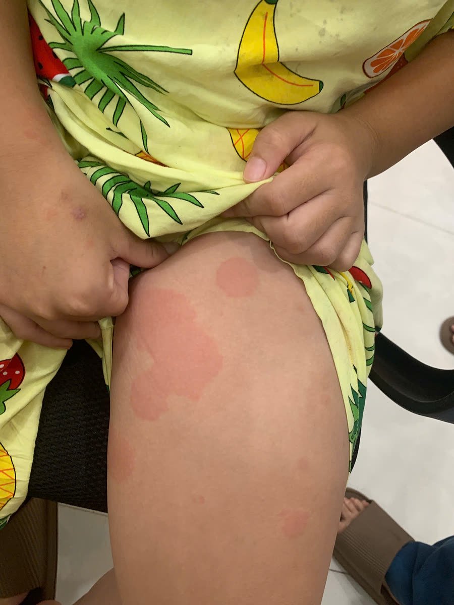 Đùi trẻ nổi mề đay với các mảng sẩn phù hồng đỏ, bờ rõ, uốn hình vòng cung