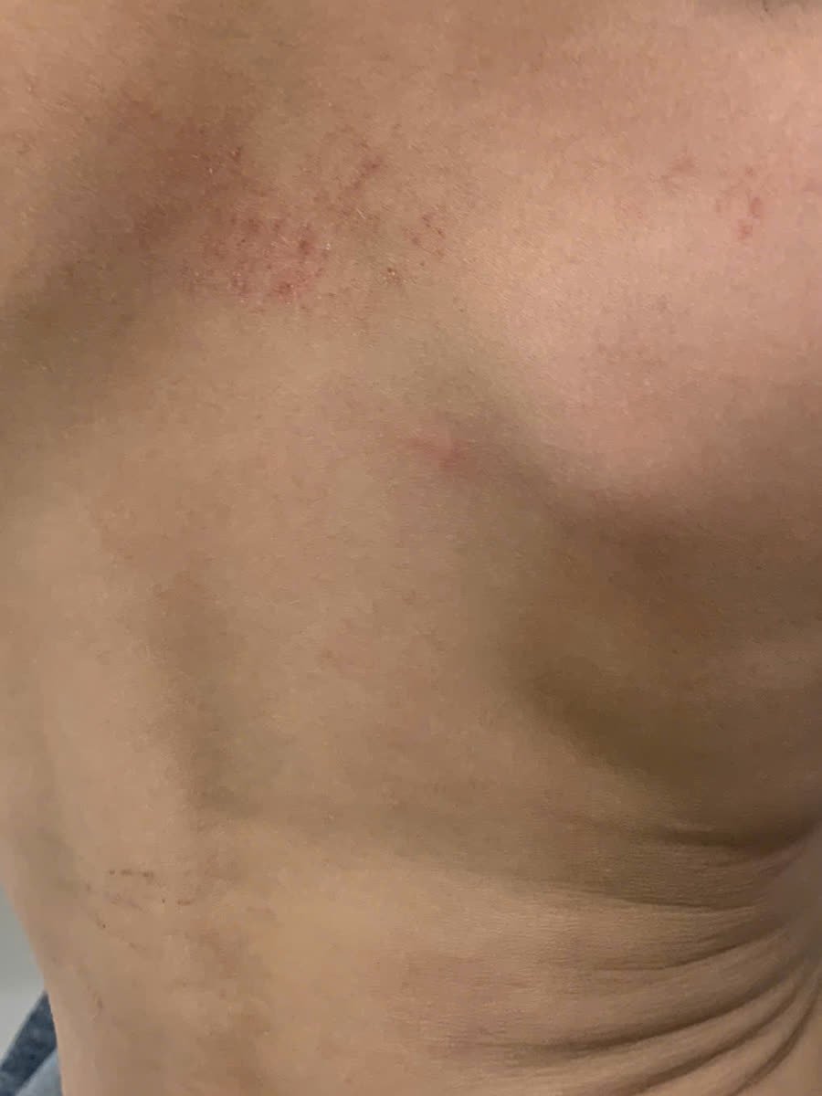 Lưng trên có một đám chấm đỏ lấm tấm trên nền hồng, vài chấm đỏ gần bả vai và vài vết gãi mảnh phía dưới