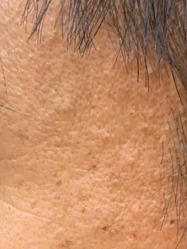 Vùng da thái dương sát chân tóc có nhiều sẩn nhỏ màu da đến nâu nhạt, mặt phẳng, hơi gồ, nằm rải rác và tụ thành đám ở vài chỗ
