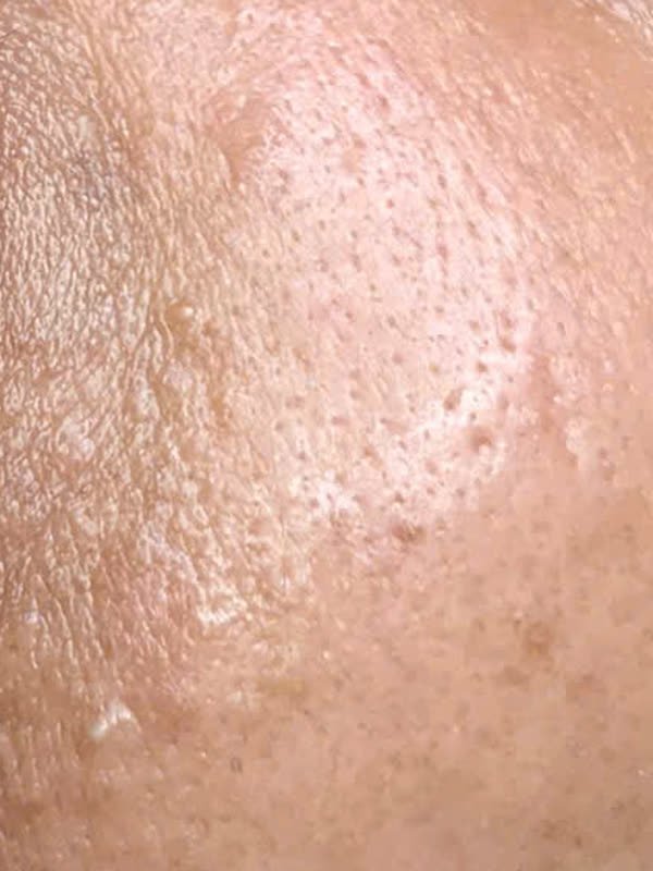 Vùng da ngay dưới mắt có vài sẩn nhỏ khoảng 1 đến 2 mm, màu da đến vàng nhạt, bề mặt nhẵn bóng, nằm rải rác trên nền da lỗ chân lông to
