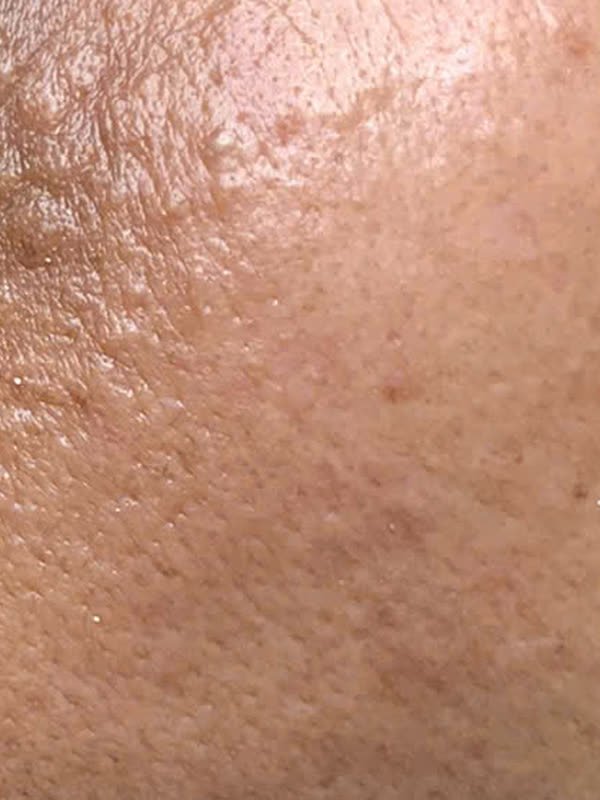 Vùng da dưới mắt bên còn lại và gò má, phần trên sát mí dưới có vài sẩn nhỏ màu da, phần gò má bên dưới có lỗ chân lông to và vài đốm nâu nhạt